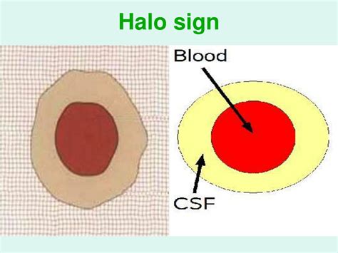 halo sign csf|Letter to the Editor: Double Ring Sign Does Not。